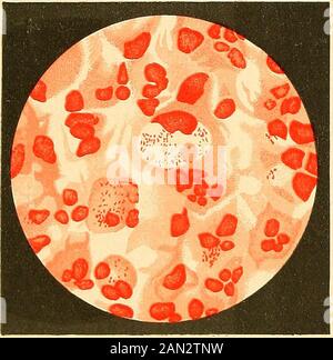 Moderna diagnosi e trattamento di malattie del childern; un trattato sulle malattie mediche e chirurgiche dell'infanzia anf infanzia . Fig. 76.-stesso figlio di Fig.6 settimane dopo. (Sheffield.) i casi, tuttavia, sono già registrati. 1 si suggerisce Il nuovo termine perché indica la sede esatta del thetroble; aiuta anche a distinguere questa condizione da emby-sema chirurgico, che è prodotto da batteri gasogenici. Capitolo IX.Communicable Malattie. Influenza(The Grip). L'influenza è una malattia acuta, trasmissibile, epidemica e sporadicmalattia dovuta al bacillo influenzale di Pfeiffer e Canon. È. Nervo d Foto Stock