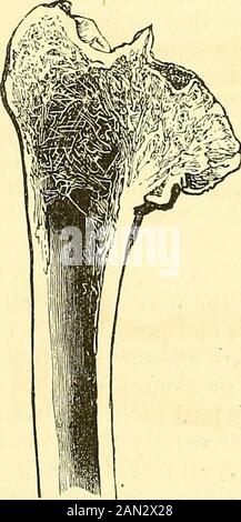 Un sistema di chirurgia : patologica, diagnostica, terapeutica e operativa . Atrofia ossea. Fig. 317. Fig. 318.. Foto Stock