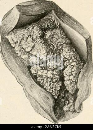 Ginecologia per studenti e praticanti . Fig. 282. Carcinoma precoce del corpo Dell'Utero. Paziente aged53. La crescita formò una massa papillaripolipoide che era attestata alla cornu destra mediante una base comparativelynarrow. La cavitàuterina ha misurato IJ pollice da fundus toexternal os. Fig. 283. Carcinoma del corpo Di Un Utero Senile. La crescita è composta da papillari o villousmasses che hanno sporgente attraverso il sistema operativo interno e dilatato la cervice varietà, ma alcuni rari casi (compreso un caso pubblicato da un ofus) di cancro squamocellulare primario dell'endometriumhav corporeo Foto Stock