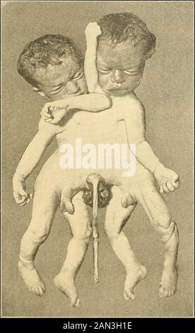 Moderna diagnosi e trattamento di malattie del childern; un trattato sulle malattie mediche e chirurgiche dell'infanzia anf infanzia . Fig. 38 (Sheffield.) stomaco nella fessura addominale, e dovrebbe essere rimediato da portare-Abdominai [ns anci che tengono i muscoli recti separati insieme per mezzo di un sostenitore. & r © ? •,,,, di fasce in gesso o bendaggi adatti. ERNIA OMBELICALE CONGENITA. (Ernia Funiculi Umbilicalis, Exomphalos, Omphalocele Congenita, Ectopia Viscerum, Amnion Navel). Come risultato di uno sviluppo difettoso delle coperture addominali, invece di un umbilicus, una dilata variamente dimensionata, saclike Foto Stock