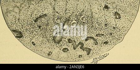 Patologia e trattamento delle malattie delle donne . ^svftp^g;.. TLG. 165.-Oophoritis Settico Acuto E Perioophoritis. Essudato purulento fibrinoso sulla superficie ovarica, infiltrazione di cellule rotonde dei tessuti, trombi settici nei vasi. (Preparazione degli autori. Zeiss, Obj. AA, Oc. 2.) Alla sezione una marcata iperemia, e per lo più un edema gelatinoso, in alcuni casi si osservano anche più piccole ascessi. Si trova un'infiltrazione microscopicamente enorme a cellule rotonde dell'intera struttura (vedere Fig.165); in luoghi esiste un rammollimento purulento ed i follicoli sono la maggior parte della cacciatorpedina. Streptococchi i Foto Stock