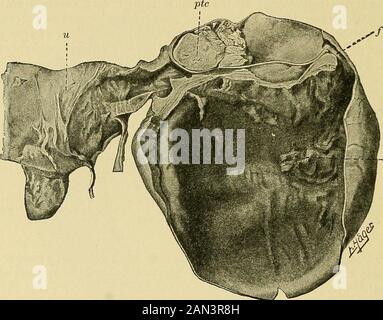 Patologia e trattamento delle malattie delle donne noma, descritta per la prima volta da Orthmann. Questo è anche un alwaysof una costruzione papillare, e ha origine principalmente sulla base di salpingite acronica (si vedano le Figg. 155 e 156). La preparazione rappresentata in Fig. 155 è stato ottenuto da una donna di cinquantasei anni, p. Sen. J., No. 366, 1904-1905; 3-para, con aumento della dimensione dell'addome per gli ultimi tre mesi, e dolori occasionali. 342 MALATTIE DELLE DONNE tumore Di Grandi Dimensioni, raggiungendo una larghezza delle mani sopra l'ombelico, localizedspecialmente nella metà destra dell'addome, con un an parzialmente cistico Foto Stock