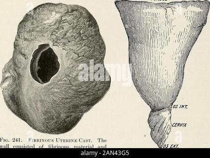 Ginecologia per studenti e praticanti . Fig. 240. DecibDual Cast,passato come abortion.The feto era stato assorbito. ANGOLO TUBO FUNDUS. Fig. 241. Cast Uterino Fibrinoso. Thewall era costituito da materiale fibrinoso e non conteneva alcun tessuto endometriale. Le tende erano sangue fluido. Da un caso di febbre tifoide. CERVICE 05 £XT. Fig. 242. Emocolato Uterino Completo. Da un caso di tonsillar septi-csemia. Pollice di lunghezza, che è separato dal corpo del cast da un shallowsulcus corrispondente alla posizione del os internum. Il campione ADENOMYOMA 489 mostrato nella figura era costituito da un SO Foto Stock