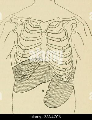 La pratica del ventesimo secolo; un'enciclopedia internazionale della scienza medica moderna da parte delle autorità principali d'Europa e d'America. Lready beendeed a, ma le fluttuazioni in formato possono a volte avere luogo con-fuori la causa dimostrabile. Sintomi che indicano il coinvolgimento del midollo osseo msbj becomeprominente. La condizione più frequente è una lieve tenerezza delle tibiae, della colonna vertebrale, o dello sterno, che provoca una notevole sensibilità topsure o colpi. In altri casi si ha dolore con la tenerezza ex-quisite nelle regioni menzionate. Questi sintomi possono manifestarsi all'inizio della malattia e possono portare a t. Foto Stock