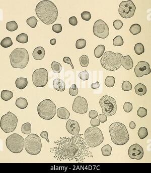 La pratica del ventesimo secolo; un'enciclopedia internazionale della scienza medica moderna da parte delle principali autorità d'Europa e d'America . le cellule di se sono di importanza comparata, anche se theyare notevolmente aumentato in numero in certi casi del tipo lieno-midollare. Nella linfsemia essi sono relativamente molto ridotti in numero. Leucociti transitori.- questi differiscono dall'ultimo solo per il fatto che il nucleo è irregolare nel contorno. Occasionalmente sono stati trovati granuli neutrofilo in salute. La relazione delle estecelle alla leucsemia è molto la stessa di quella delle grandi mononuclearociti; infatti, Foto Stock