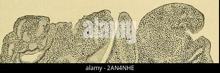 Patologia e nel trattamento delle malattie delle donne . yof che è del tutto inspiegabile, è stato designato dysmenorrheamembranacea sul conto dei disturbi ad essa connessi. Anatomicamente l'epitelio superficiale della membrana espulso isalmost sempre trovato distrutto. Le cellule dello stroma sono gonfi e stainwith difficoltà, come le cellule decidual. Con essa esiste un abundantround infiltrazione cellulare e una permeazione di tutta la mucosa con siero.L'epitelio ghiandolare è spesso esfoliata, ma altre volte ancora wellpreserved (vedere Fig. 99). Questa espulsione degli strati superficiali di Foto Stock