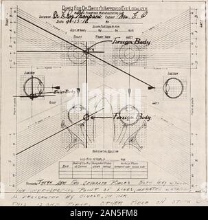 Ufficiale di oftalmologia, otology e laryngology . E. O. Caso n. 6. Diagnosi: la penetrazione del bulbo oculare da uno o più corpi estranei.prognosi: probabile l'enucleazione. Trattamento: Atropin soluzione di solfato, 1 per cento., una goccia ineye ogni cinque minuti per tre dosi, che ha ottenuto una buona dilatazione.paziente è stata quindi in grado di contare le dita ; fundus reflex è diventato visibile;oftalmoscopiche esame rivelato emorragia interoculare sullato inferiore campo. Immagini radiografiche, utilizzando le caramelle localizationmethod, mostrava due distinti corpi estranei profondamente integrati. Patientwas messo in ospedale e reso Foto Stock