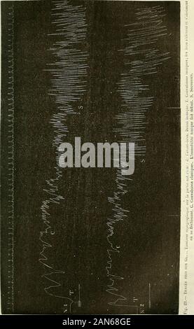 Études cliniques sur l'hystéro-épilepsie, ou Grande hystérie . Fig. 1%. Fase de la risoluzione. Ouehiues contratture partielles persistente. Le sommeil est parfois interrompu par des secousses généralesqui soulèvent complètement la malade et la font quelquefois seramasser en boule (fig. 30). Elle y demeure fort peu de temps etretombe aussitôt dans un relâchement musculaire complet. DE LA GRANDE ATTAQUE HYSTÉRIQUE. 61. 62 DE LA GRANDE ATTAQUE HYSTÉRIQUE. Les secousses, peuvent être partielles, occuper les membres oula faccia. Foto Stock