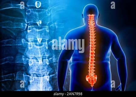 Vista posteriore di un uomo obesi con il suo dorso o a spina dorsale e vertebre x-ray in background. Sovrappeso e lesioni alla schiena 3d rendering illustrazione. Indietro Foto Stock