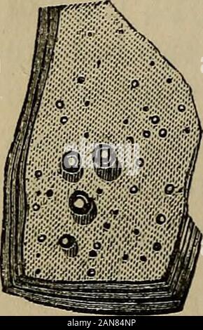 Una pratica Treatise on urinario e malattie renali : inclusi depositi urinaria . mposed di un opalescente sostanza tremulous resemblingboiled bianco d'uovo. Quando ha esaminato moreclosely, si è scoperto avere un laminato struc-ture (Fig. 70), e di essere costituito da un im-mense numero di lamellse sottile o strati che,sotto il microscopio, presentano un perfettamente omo-geneous struttura. Entro la cavità della cysta numero di secondari o figlia-cisti floatfreely in una soluzione salina acquosa fluido, il quale è privo ofalbumen.t la figlia-cisti variano in dimensione froman arancione per un pisello o perni testa: essi mayeven essere mu Foto Stock