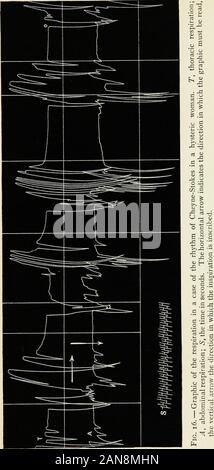 I principali sintomi di isteria : quindici lezioni nella scuola di medicina dell'Università di Harvard [tra il quindicesimo giorno del mese di ottobre e la fine di novembre, 1906] . Cheyne-Slokes nell'isteria.1 Sapete che circa il 1816, Cheyne di Dublino andStokes descritto un certo molto speciale ofrespiration irregolarità che, alla loro mente, era una caratteristica dei più gravi stati. Come è possibile vedere in questa tabella (Figura16), questo ritmo è caratterizzato da pause respiratorie;c'è una serie di dieci a quindici respiri veloci, quindi anarrest della respirazione che può durare a lungo e metà aminute in alcuni casi; Foto Stock