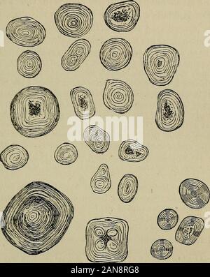 Una pratica Treatise on urinario e malattie renali : inclusi depositi urinaria . ossess a pieno colore ambrato,e sono finemente traslucido. Sotto il microscopio essi pre-inviato le apparenze rappresentata in Fig. 47, e presentano aninfinite serie di linee concentriche. Il centro o nucleusis variamente composto. In alcune di esse è un objectresembling una cella ghiandolare, in altri un cristallo prismatico,in altri terreni amorfo-cercando la materia. In alcuni, nuovamente,il nucleo è il doppio, in altri alti, o anche quadruple(Fig. 47). Con luce polarizzata che visualizzano una croce scura, asrepresented nella parte inferiore Foto Stock