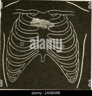 L'esame medico per le assicurazioni sulla vita e i suoi associati metodi clinici : con capitoli su assicurazione della vita declassati e di assicurazione contro gli infortuni . Fig. 26. Anemia.- {Sansom.) 1 sito di mormorio-pulmo(59 per cento dei casi). Fie :i ? San mormorio nella zona aortica. (11%,di casi). Foto Stock