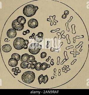 Una pratica Treatise on urinario e malattie renali : inclusi depositi urinaria . che sono necessariamente depositato underthose circostanze. La urato di ammoniaca è di solito adense colore bianco; ma ho conosciuto possiede una tonalità beautifulviolet. Due forme sono visibili sotto il microscopio. La maggior parte com-mon sono sfere e masse globulari,che appaiono quasi nero da trans-mitted luce, a causa della loro opacità(vedi Fig. 11. a). Queste sfere areeasily ottenuto lasciando un urinecontaining amorfo tostand urato in aria fino a che non becomesammoniacal. La seconda forma (u)si verifica come molto minute slende Foto Stock