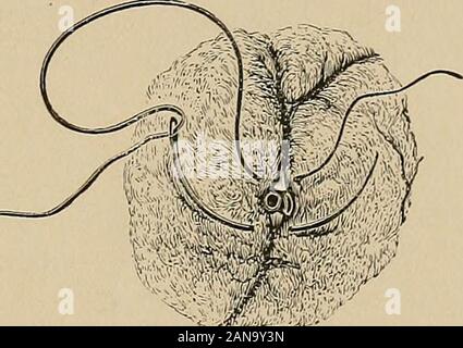 Le regole dell'asettico e ambulatorio antisettico; un Trattato pratico per l'uso degli studenti e il medico di medicina generale . Fig. 22. Emostatici ago.. Fig. 23.-modo ot ap]&GT;l^ ing haemostaticneedle (E&marcli). come una borsa-string. Essendo legata, chiude la Foto Stock