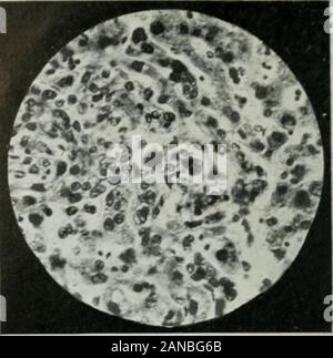 Gazzetta del laboratorio e medicina clinica . Fig. 15.-(stesso di Fig. 10.) il tumore di rightovary. 6 cm di diametro. Due tipi di carcinoma.tipo diffuso miscelato con filamenti di solido. (S.e. X350 diam.). Fig. 16.-(stesso come lig. 10.) .patologie maligne degen-erazione di fegato-trabecula. Questo tipo di ma-lignancy era otjserved in ogni sezione. No met-astatici noduli sono stati trovati. (H.R. x300 diam.) Foto Stock