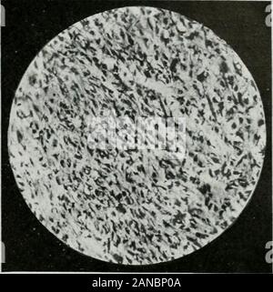 Gazzetta del laboratorio e medicina clinica . Fig. 2.-(stesso di Fig. 1.) proliferazione ofcartilage. (S.e. x250 diam.) Fig. 3.-(stesso di Fig. 1.) la proliferazione di con-nective tessuto. (S.e. X 250 diam.) Foto Stock