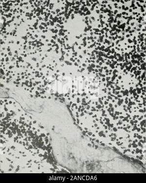 Gazzetta del laboratorio e medicina clinica . Fig. 1.-una sezione che mostra la presenza di truebone e midollo osseo nella ghiandola surrenale. Iig. 2.-una sezione che mostra mas?ing di cellule smallround circa l'osso nella ghiandola surrenale.. Foto Stock