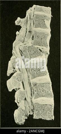 Un libro di testo di anatomia clinica : per studenti e professionisti . ackwardcurve (gibbus o cifosi) ex-tende su una notevole por-zione della colonna vertebrale (vedere Fig. 164).Di solito è compensata bycurves nella opposta directionin il nonaffected regioni. (C) artrite reumatoide o osteoar-thritis della colonna vertebrale.-Questo causesa curva indietro che coinvolgono theentire colonna vertebrale. (D) le malattie infettive (tifo,gonorrea, Scarlatina, ecc.).- provocare una curva indietro che può o non può diventare per-manent. Traumi.-Un marcato cambiamento di profilo possono provocare improvvisamente,come dopo una frattura-la dislocazione della vertebra Foto Stock
