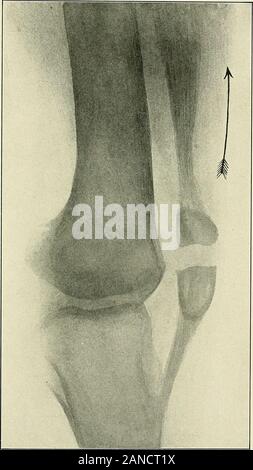 Un libro di testo di anatomia clinica : per studenti e professionisti del settore . Fig. 149.-Tabetic a ginocchio. La figura riportata di seguito mostra le enormi enlargementof la estremità inferiore del femore come risultato di disturbi trofici e la capacità di rapimento produceabnormal nell'articolazione del ginocchio. 467. Fig. 150.-frattura della rotula (realizzata da #-ray), la freccia mostra la azione del quad-riceps estensore in tirando i frammenti superiore verso l'alto, di dimostrare come la spaccatura di in-violenza diretta (azione muscolare) possono verificarsi. 469 LA GAMBA. 471 Grazie a questa posizione superficiale il periosteo è frequentemente la seatof una traumatica inflammati Foto Stock