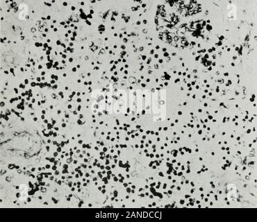 Gazzetta del laboratorio e medicina clinica . Fig. 4.-la stessa della Fig. 3, ma con ancora maggiore ingrandimento. per essere luetic. Fischer ha richiamato l attenzione per la somiglianza della foto a quelladel anemia iiifantutn pseudoleukaemia e ha suggerito che questo kakophoniouslynamed malattia potrebbe essere una forma esagerata, o un ulteriore sviluppo di fetalanemia in cui criteri potrebbe essere simile a, anche se meno accentuata rispetto a thoseof il tipo erythroblastosis. Uno dei casi Schriddes è stato derivato da un ne-phritic madre ma in questo caso egli ritiene che le condizioni del feto è stato coin-cidental e non il Foto Stock