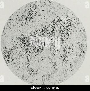 Gazzetta del laboratorio e medicina clinica . Fig. 11. Ghiandola surrenale, ad alta potenza, infiltrazioni perivascolari intorno a un capillarj-. Fig. 12.surrenali, diffusa infiltrazione del midollo. "F T ^^-^?A.l, Fig. 13.retto, ulcerazione e infiltrazioni. Foto Stock