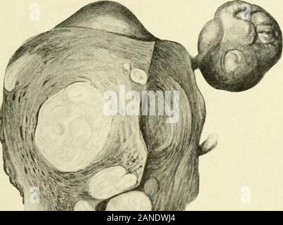 Fibromi e allied tumori (mioma e adenomyoma) : la loro patologia, caratteristiche cliniche e trattamento chirurgico . Per FACK. Pagina 97 Il cancro del corpo 97 della crescita dal cancro-cellule. La diffusione di cancro-cellule ha preso la linea di minor resistenza e correva lungo la. Foto Stock