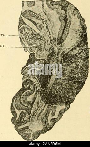 Sémiologie et diagnostic des maladies des animaux domestiques sée .. La capsula in terne. - I.en-semble deslibres qui tra-versentlescorpsstriés lorment lacapsule interne. 3 sterline! On peut distin guer-deux par-lega : linlerne,la plus prochedes divani op-tiques,estappe-porzione lée len-iicnlo-opiique. Sa destructionest suivie dunehéinianesthésie Fig. 28. - Hémorragie cérébrale (liaprùs lioucliard crOiSéC J elle com- et Charcol). -, • Prend donc sur- Tli, talamo.- CE, corps genouillé externe. - TOUt fibersFS dcs, faisceau sonsitif. - L, lésion de ihémianesHiésie .   , ?Dans le carrefour sensitif. sensi Foto Stock