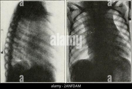 Endoscopia perorale e chirurgia laringea . del padiglione auricolare cardiaco. In un tale caso theauthor trovato il Bronco sinistro quasi chiuso e l'esofago così com-premuto da interferire seriouslv con la deglutizione. Vi è stato un i&GT;osticusparalysis del lato sinistro della laringe. L'autore ha visto ERONCnOSCOI tracheale-Y in malattie della trachea e dei bronchi. 471 compressione a causa di enfisema mediastinica provocata da una caduta verso il basso stairs.Compression stenosi della trachea associato emphy polmonare-sema è stato studiato in trentadue casi da Kahler (Bib. 21G), whonotes che la stenosi diventando molto w Foto Stock