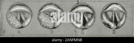 Endoscopia perorale e chirurgia laringea . si affidano scomparso, lasciando entrambi aryepiglottic HNDOSCOP 4-40-I- IN DISKASK MALIGNE DELLA LARINGE. pieghe e arytenoids quasi simmetrica come illustrato in corrispondenza di C. Tiiere wasquite una motilità imjiroved del diritto arytenoid, benchè non sia stata ableto rendono più della metà di una normale escursione. Il paziente non è stato seenagain fino a due mesi più tardi quando si è scoperto che vi era un ede-matous-cercando un leggero allargamento del diritto aryepiglottic piega, thoughit non era nodulari e non di colore scuro della condizione primaria.verso il basso sulla superficie posteriore di destra Foto Stock