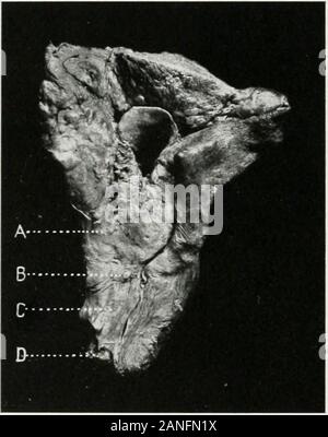 Endoscopia perorale e chirurgia laringea . ngoscojiic andesophagoscopic esame della parte a parete, sulla sua anteriore e pos-terior superfici. La temperatura esofagea s]ieculnm è utile qui. In un numero di casi l'autore ha trovato il coinvolgimento della p;irty parete sottole arNtenoids posteriormente in casi esenti da ;ntenoid lixation andseemingly intrinseco. In (jther casi, e.xtrinsic da (origine o estensione, hehas sconsigliato laryngectomy a causa di nodi ghiandolare osservabili 4;i8 endoscopica in malattia maligna della laringe. esophagoscopically nell'esofago, anche se coperti con apparentlyno Foto Stock