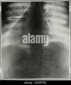 Endoscopia perorale e chirurgia laringea . Fig. 373.-La radiografia mostra stickpin in Bronco sinistro di un ragazzo di fifteenyears. Il pin è stato rimosso per via orale broncoscopia. La radiografia fatta Ijy il roent-genologist dell'ospedale tedesco, Philadelphia. (.Authors caso.) casi illustrativi OE ENDOSCOPIA lOR CORPI ESTRANEI. 407. Foto Stock