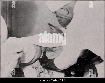 Le transazioni della Associazione americana di ostetrici e ginecologi e chirurghi addominale per l anno ... . Fig. 9.-spalla anteriore consegnato sotto il pube arch.. Fig. 10.-rotante spalla posteriore alla posizione di anteriorshoulder. rotazione del corpo childs in modo tale che il braccio posteriore ora becomesanterior. 5. Non ho mai affrettare la consegna dopo l'umbilicus entra in vista da causare l'esperienza mi ha insegnato che la fretta è inutile; che severecomplications come estensione dei bracci e della testa sono molto Foto Stock