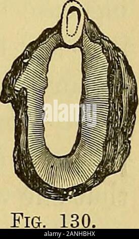 Note cliniche sulla chirurgia uterina : con particolare riferimento alla gestione della condizione sterile . seconda operazione,e che è stato senza dubbio il risultato della imperfectexcision della base ispessita della membrana thehymeneal. Questo caso provesvery conclusivamente quanto è importante toexsect imene nella sua totalità; per quiun piccolo punto è stato lasciato che produceva greatsuffering successivamente. Ma per mostrare a agreater certezza la decenza di thiscourse di trattamento, mi si riferiscono qui amost notevole caso che cadde sotto la mia osservazione a pochi anni fa. Una donna di età compresa tra i trenta, era sposata a venti-on Foto Stock