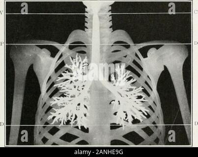 Endoscopia perorale e chirurgia laringea . BODIi esteri:S nella laringe e TRACHKA. 239 può essere un punto di vitale importanza. Jhcre è un'altra classe di casi, howeer, in cuiè intnider non può mai essere trovato se non vi è stato alcun preciso localiza-zione. Piccoli corpi estranei o quelle piccole in un diametro, thegeneral seguente regola di corpi estranei nei passaggi di aria, continua a scendere-ward fino ad arrivare al più piccolo bronco possibile. Così needlesand piccole spine con testa di ottenere molto in basso e ery lontano verso theperijihery del polmone e in un piccolo ramo di bronco che. Fig. i66. Illustratio Foto Stock