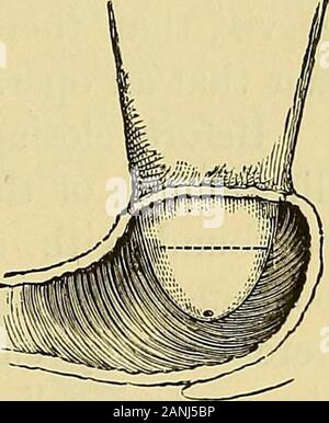 Note cliniche sulla chirurgia uterina : con particolare riferimento alla gestione della condizione sterile . ses, che era semplicemente di incisione os andcervix; e lo stesso errore è stato fatto da tuttigli altri chirurghi. Ora propongo di amputare una porzione del cervixin tutti tali casi, allo scopo di dare come neara forma normale come possibile. Ad esempio, in fig. 82, letthe cervice essere amputata a thepoint designato dalla clottedline. Noi tutti abbiamo avuto paura di trun-cate cervice in questo modo (se anyof noi mai pensato prima),e sono stati soddisfatti con simplysplitting it up per la franchigia Foto Stock