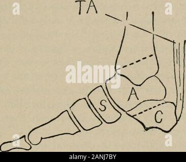 Intervento chirurgico, per studenti e professionisti del settore . Fig. 344.-Il piede destro, lato interno. Un, astragalo; C, os calcis; .Sf, sca-phoid; TA, tendo Achilis. Le linee tratteggiate indicano linee di sezione attraverso thebones in Pirogoffs amputazione. crrl. Fig. 345.-Il piede destro, lato interno. Le linee tratteggiate mostrano la sezione throughbones. Modifica Giinthers. TA^I ^^ Foto Stock