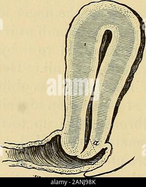 Note cliniche sulla chirurgia uterina : con particolare riferimento alla gestione della condizione sterile . del grembo prima che fosse sufficientlydilated, e il sistema operativo è stato, di conseguenza, lacerata fromside a lato. Questo guariva lentamente, ma lei remainedsterile successivamente. Fig. 72 rappresenta l'aspetto del os: theanterior metà della cervice per due volte è stato spesso come theposterior, mentre il labbro posteriore del-l'os over-lappedthe anteriore, chiusura valvularly e perfettamente. La cervice è stata indurated e thecicatrices risultanti da thelaceration e subsequenthealing potrebbe essere distinctlyseen extendin Foto Stock