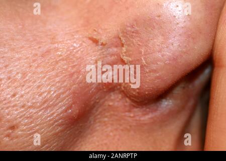 Ha infiammato la pelle del viso. L'Acne. Brufoli sulla pelle. Cicatrici e peeling. Foto Stock