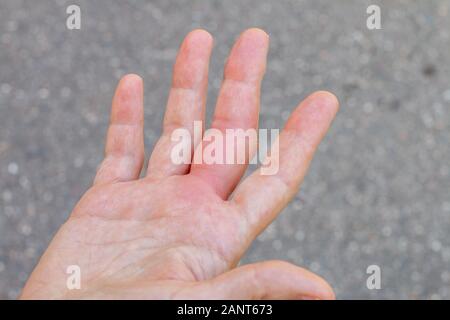 Una mano destra con un'ape, wasp bite mark, gonfiore mano, gonfiore del dito, la mano in caso di puntura d ape, bite Foto Stock