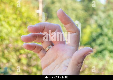 Una mano destra con un morso di ape mark, gonfiore mano, gonfiore del dito, la mano in caso di puntura d ape durante un giorno di estate Foto Stock