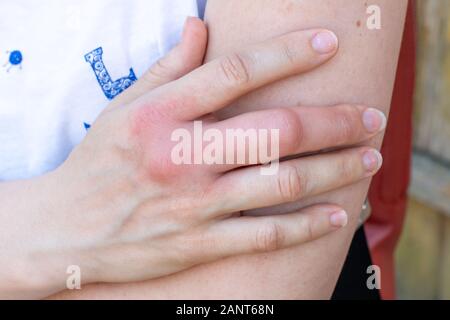 Una mano destra dopo un'ape, wasp bite, gonfia liscivie a mano su un braccio destro Foto Stock