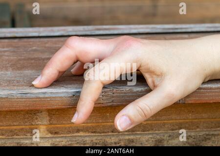 Una mano destra con un morso delle api, vespe mark, gonfiore mano, gonfiore del dito, la mano in caso di puntura d ape, bite Foto Stock