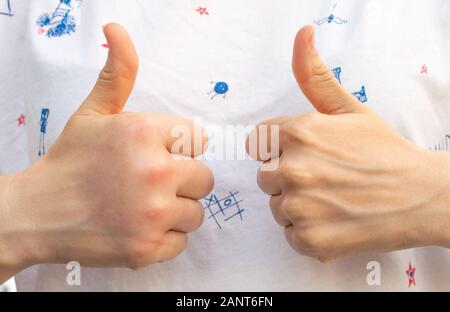 Una mano destra con un palm rigonfiata rispetto a una dimensione normale mano sinistra, mano dopo un'ape, wasp sting, bite rispetto a mano normale Foto Stock