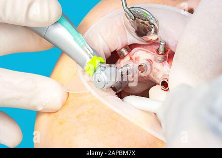 Primo piano della chirurgia implantare guidata digitale sul paziente - nuova tecnologia implantare in odontoiatria. Foto Stock