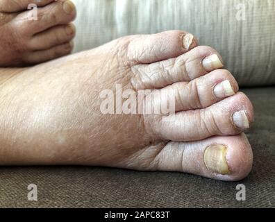 piedi di un paziente che ha edema polmonare con unghie danneggiate a causa di funghi e atleta Foto Stock