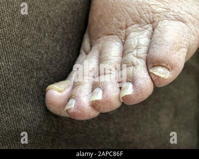 chiodo di garofano del piede femminile con chiodi danneggiati a causa di fungo Foto Stock