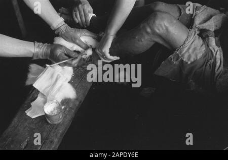 Croce rossa a Medan Descrizione: Arnhemia: La popolazione - forzata evacuata dal TNI per la liberazione della città e finalmente liberata dalle truppe olandesi - ritornata in una condizione più che miserabile nella loro città natale. Qui furono accolti dalla Croce Rossa Olandese e ricevettero rifugio, abbigliamento, cibo e, soprattutto, cure mediche urgenti. Medici e infermieri specializzati aiutano le centinaia di pazienti: Lambosia, malaria, edema, berrie-berrie. Data: 8 Ottobre 1947 Località: Arnhemia, Indonesia, Indie Orientali Olandesi, Sumatra Foto Stock