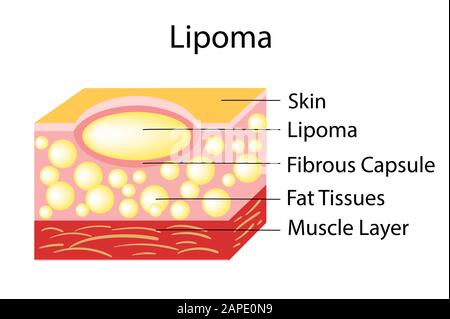 I lipoma sono tumori adiposi situati nei tessuti sottocutanei. Illustrazione Vettoriale