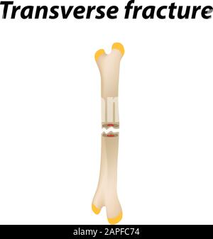 Frattura ossea trasversale. Infografiche. Illustrazione vettoriale su uno sfondo allineato. Illustrazione Vettoriale